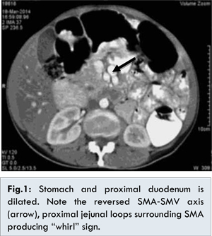 ligament of treitz ct